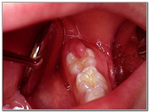 Nhổ răng số 8 có nguy hiểm không? 3