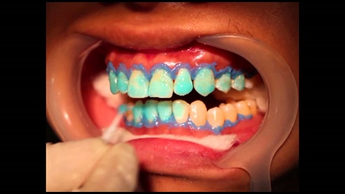 Tẩy trắng răng có ảnh hưởng gì không? Ưu và nhược điểm 1