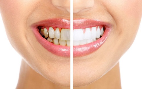 Tẩy trắng răng có ảnh hưởng gì không? Ưu và nhược điểm 2 Tẩy trắng răng có ảnh hưởng gì không? Ưu và nhược điểm 2
