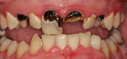 Trám răng cửa bị sâu giải quyết tình trạng mất răng 1 Trám răng cửa bị sâu giải quyết tình trạng mất răng 1