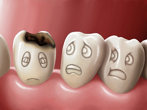 Trám răng cửa bị sâu giải quyết tình trạng mất răng 2