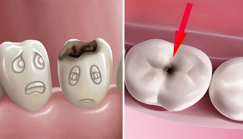 Trám răng sâu giúp ngăn ngừa nhiều biến chứng khôn lường 2