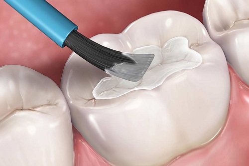 Trám răng sâu giúp ngăn ngừa nhiều biến chứng khôn lường 3