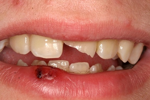 Trám răng cửa bị mẻ có duy trì được lâu dài không? 1