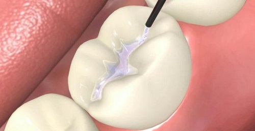 Trám răng cửa bị mẻ có duy trì được lâu dài không? 2