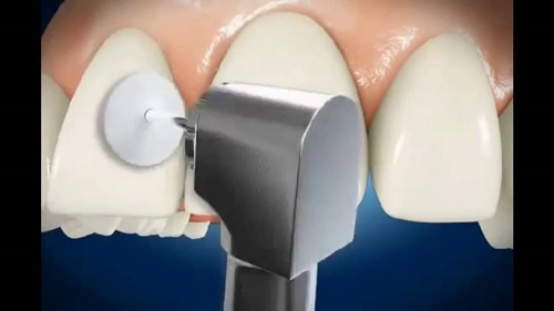 Trám răng cửa bị mẻ có duy trì được lâu dài không? 3
