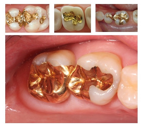 Trám răng hàm dưới giải pháp điều trị an toàn hiệu quả 1