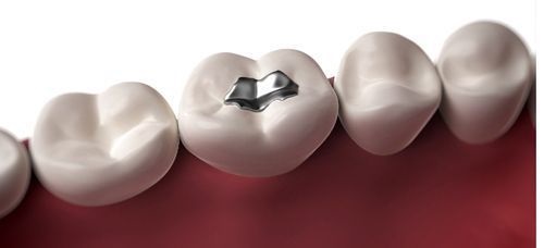 Trám răng hàm dưới giải pháp điều trị an toàn hiệu quả 2