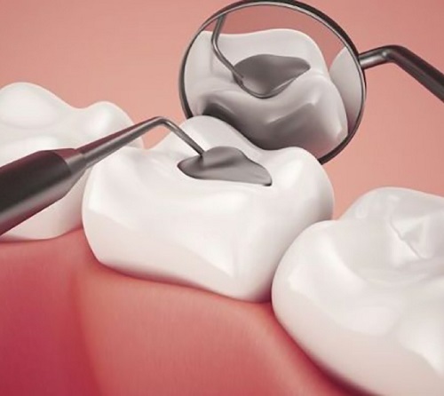 Trám răng hàm dưới giải pháp điều trị an toàn hiệu quả 3