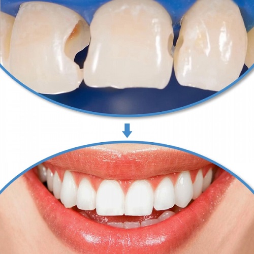 Trám răng hàm trên được áp dụng cho trường hợp nào? 1