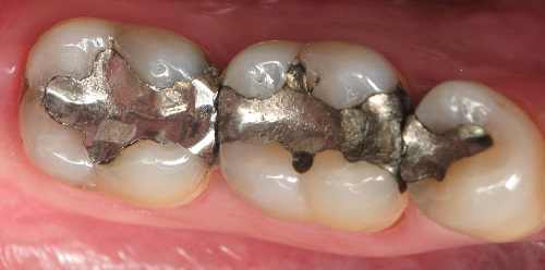Trám răng mất bao nhiêu thời gian cho 1 quá trình thực hiện 1