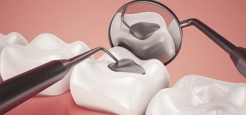Trám răng nên ăn gì để mang lại hiệu quả lâu dài nhất? 2