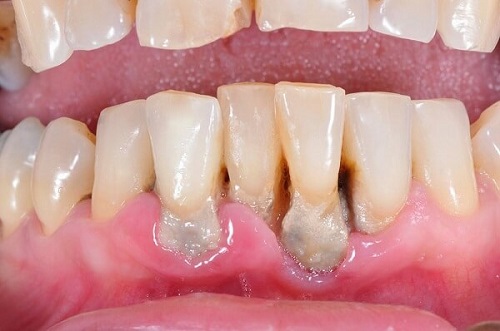 Lấy cao răng có đau hay không? Cần tư vấn 2
