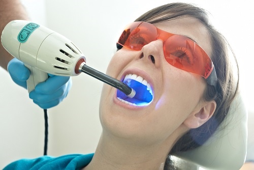 Tẩy trắng răng bằng than hoạt tính có hiệu quả tức thì không? 3