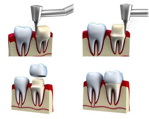 Bọc răng sứ bị cộm - Cách khắc phục nhanh chóng-2 Bọc răng sứ bị cộm - Cách khắc phục nhanh chóng-2