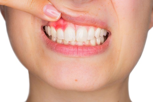 Bọc răng sứ bị cộm - Cách khắc phục nhanh chóng-3
