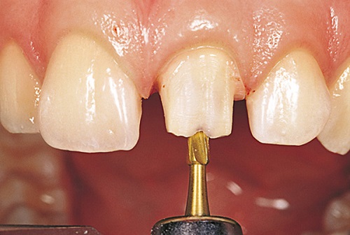 Bọc răng sứ cercon - Những ưu và nhược điểm nổi bật-2