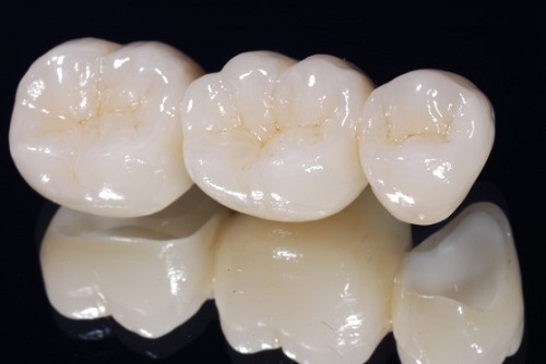 Bọc răng sứ cercon - Những ưu và nhược điểm nổi bật-3 Bọc răng sứ cercon - Những ưu và nhược điểm nổi bật-3