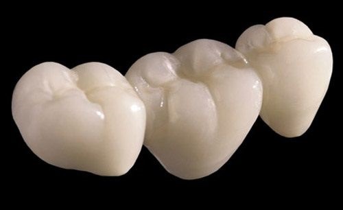 Bọc răng sứ cercon có đắt không? Giá răng sứ ceron-2