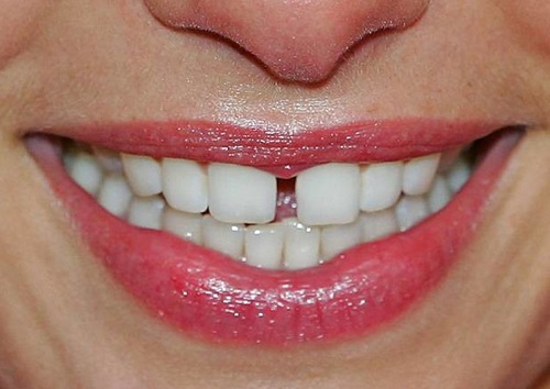 Bọc răng sứ cho răng cửa mọc lệch - Giải pháp thẩm mỹ nha khoa-1