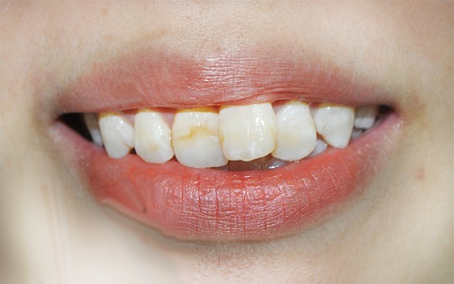 Bọc răng sứ cho răng cửa mọc lệch - Giải pháp thẩm mỹ nha khoa-2