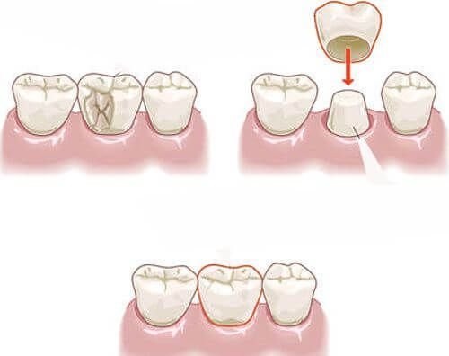 Bọc răng sứ cho răng cửa mọc lệch - Giải pháp thẩm mỹ nha khoa-3