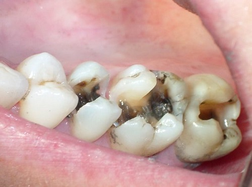 Bọc răng sứ cho răng hàm sâu được thực hiện ra sao?-1 Bọc răng sứ cho răng hàm sâu được thực hiện ra sao?-1