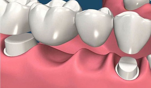 Bọc răng sứ cho răng hàm sâu được thực hiện ra sao?-2