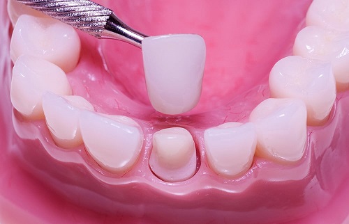 Bọc răng sứ có ảnh hưởng gì không? Tìm hiểu thông tin-2