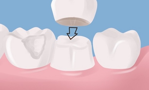 Bọc răng sứ không cần mài răng có hiệu quả không?-3 Bọc răng sứ không cần mài răng có hiệu quả không?-3