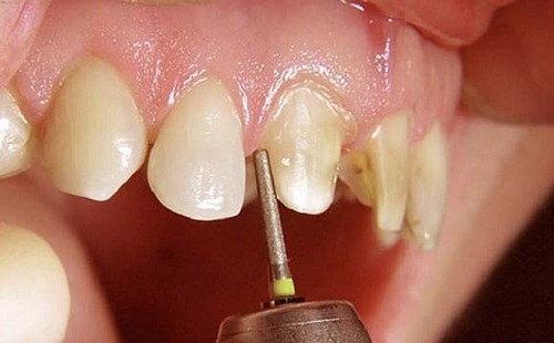 Bọc răng sứ nguyên hàm giá bao nhiêu là thực hiện được?-3