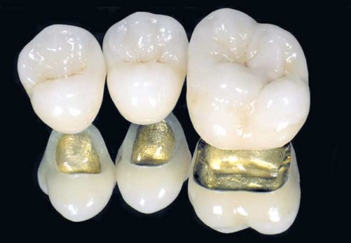 Những điều cần biết khi bọc răng sứ zirconia-2