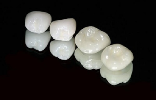 Bọc sứ răng cửa giá bao nhiêu tiền cho một lần thực hiện 2 Bọc sứ răng cửa giá bao nhiêu tiền cho một lần thực hiện 2