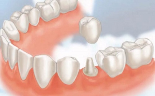 Chụp răng sứ giá bao nhiêu? Có đắt không-2 Chụp răng sứ giá bao nhiêu? Có đắt không-2