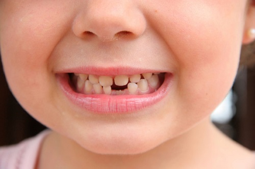 Có nên bọc răng sứ cho trẻ em không? Thông tin cần biết-1 Có nên bọc răng sứ cho trẻ em không? Thông tin cần biết-1