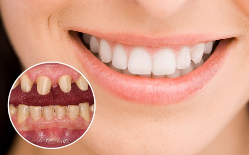 Có nên bọc răng sứ titan? Tìm hiểu ưu điểm răng sứ titan-2