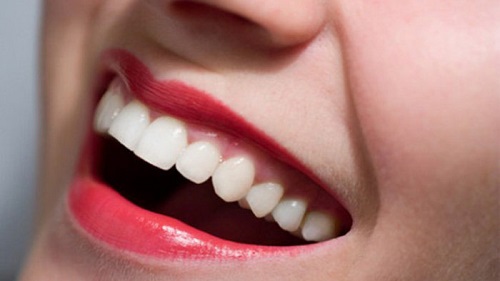 Có nên bọc răng sứ titan? Tìm hiểu ưu điểm răng sứ titan-3
