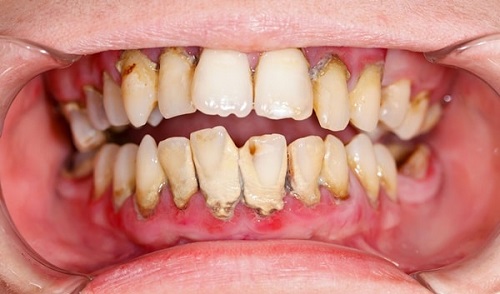 Lấy cao răng bao nhiêu tiền? Có đắt không 1 Lấy cao răng bao nhiêu tiền? Có đắt không 1
