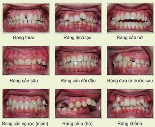 Niềng răng có hại gì không? Sức khỏe nha khoa 1