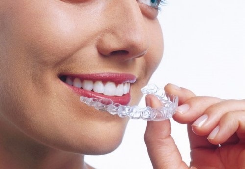 Niềng răng có hôn được không? Tham khảo ý kiến nha khoa-2 Niềng răng có hôn được không? Tham khảo ý kiến nha khoa-2