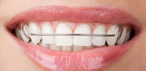 Niềng răng cửa bị mọc lệch cải thiện thẩm mỹ-2 Niềng răng cửa bị mọc lệch cải thiện thẩm mỹ-2