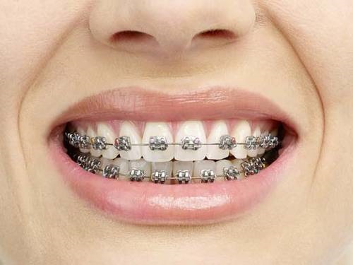 Niềng răng cửa giá bao nhiêu? Có khác niềng răng khác không-2 Niềng răng cửa giá bao nhiêu? Có khác niềng răng khác không-2
