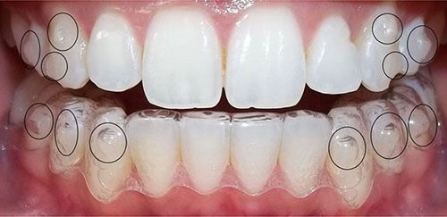 Niềng răng không mắc cài 3d clear aligner - Dịch vụ thẩm mỹ-1 Niềng răng không mắc cài 3d clear aligner - Dịch vụ thẩm mỹ-1