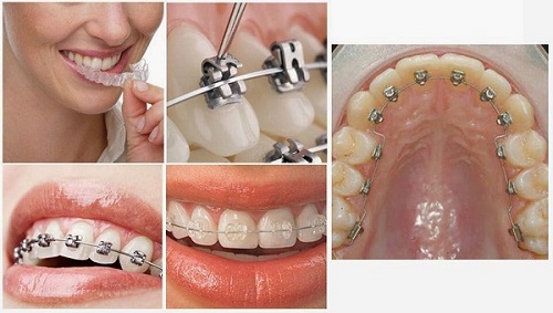Niềng răng một hàm có được không? Tư vấn nha khoa 3