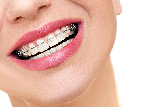 Niềng răng một hàm có được không? Tư vấn nha khoa-4 Niềng răng một hàm có được không? Tư vấn nha khoa-4