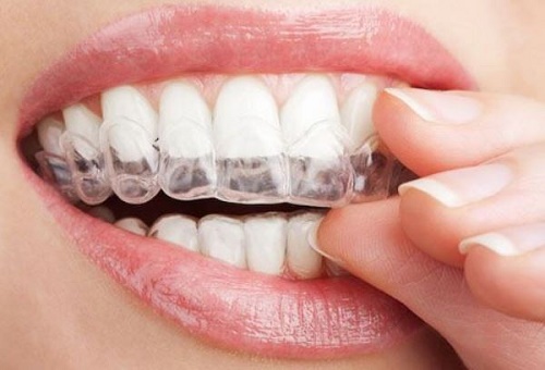Chỉnh răng đều không cần niềng mang lại kết quả thế nào? 2