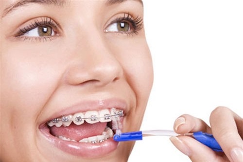 Lý giải vấn đề - Niềng răng có làm răng yếu đi không?-3 Lý giải vấn đề - Niềng răng có làm răng yếu đi không?-3