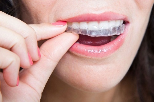Niềng răng invisalign có đau không? Nên lưu ý gì trước khi thực hiện-3 Niềng răng invisalign có đau không? Nên lưu ý gì trước khi thực hiện-3