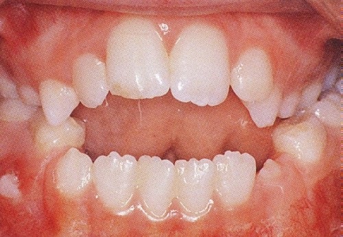 3 lợi ích khi niềng răng khớp cắn hở bạn nên biết-1