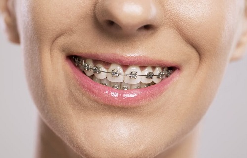 Niềng răng người lớn giá bao nhiêu? Gợi ý mức chi phí cho bạn-1 Niềng răng người lớn giá bao nhiêu? Gợi ý mức chi phí cho bạn-1